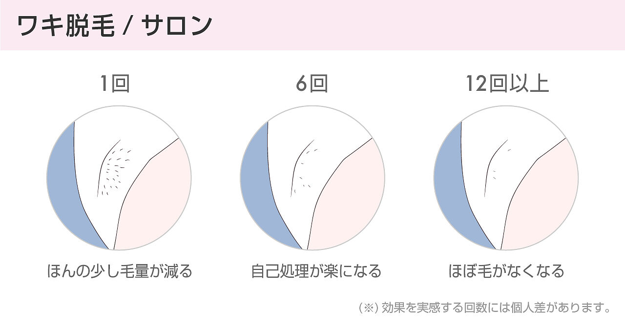 ワキ脱毛が安い理由はなぜ おすすめサロン 医療クリニック10社の紹介も 女子spa